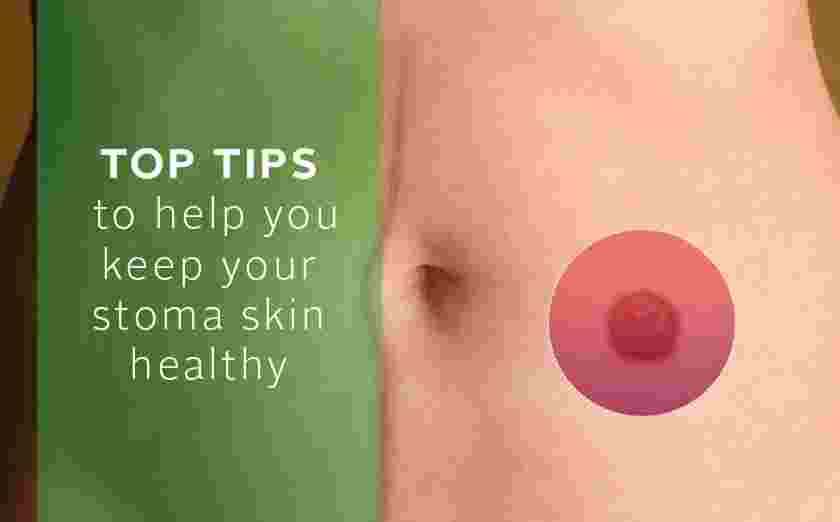 Top tips for maintaining healthy stoma skin